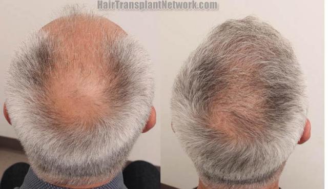 Surgical hair transplantation result photographs