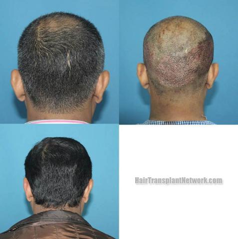 Hair replacement surgery before and after images