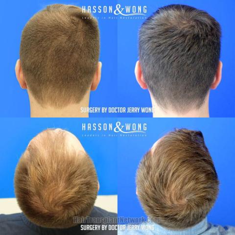 Hair replacement surgery before and after images