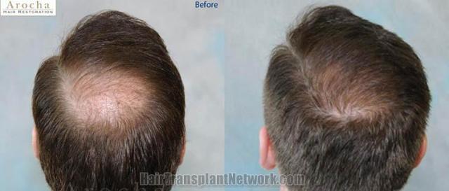 Crown hair transplant before and after images