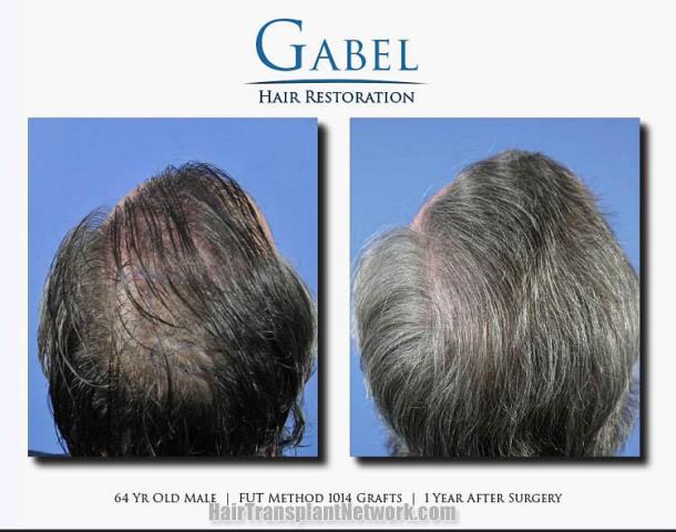 Surgical hair transplantation result photographs