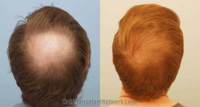 Hair transplantation surgery before and after photos