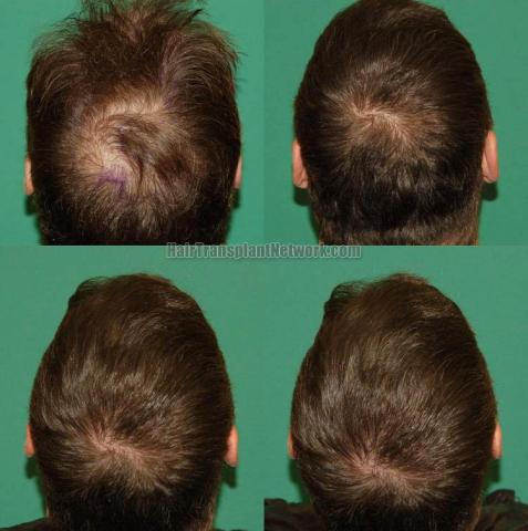 Hair restoration procedure before and after pictures