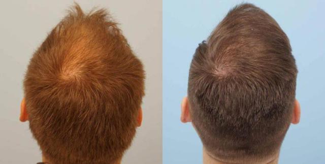 Hair transplantation procedure before and after photographs