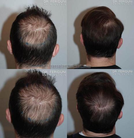 Hair transplantation procedure before and after photographs