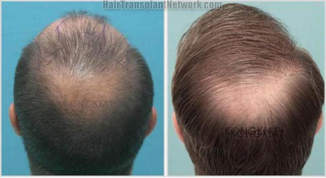 Hair transplantation procedure before and after photo results