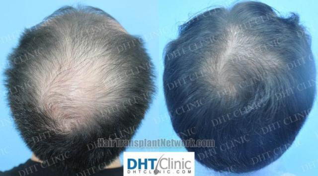 Hair replacement surgery before and after images