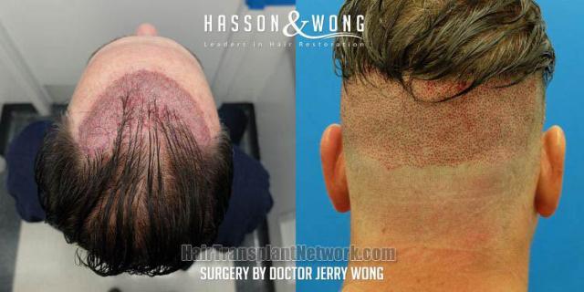 Hair restoration procedure before and after result images