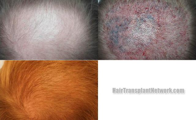 Hair transplantation surgery before and after images