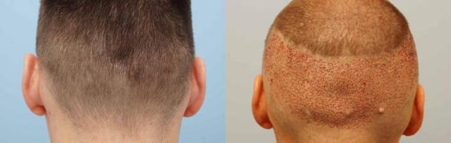 Hair transplant surgery before and after images