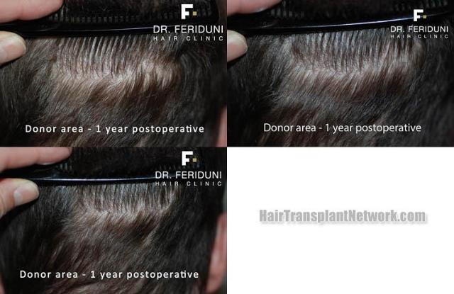 Hair transplant surgery before and after images