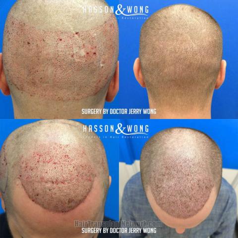 Hair restoration procedure before and after pictures