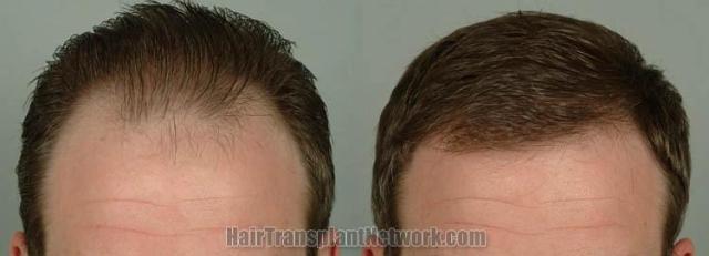 Before and after hair transplantation result photographs