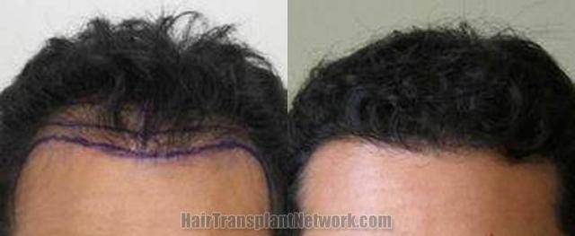 Hair transplantation surgery before and after photos