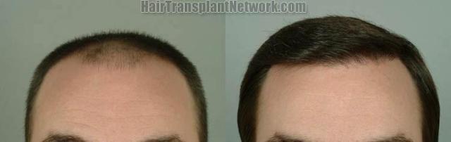 Hair transplantation surgery before and after pictures