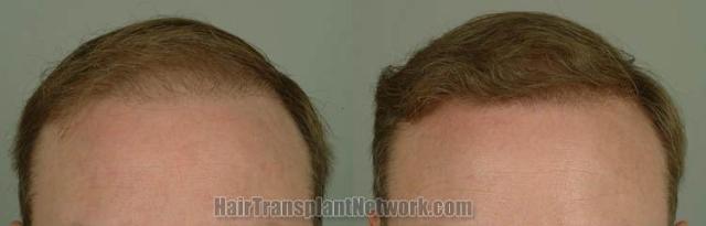 Hair restoration procedure before and after results