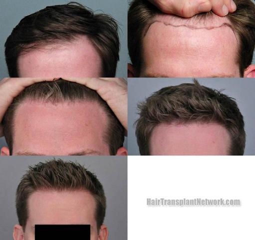 Hair restoration procedure before and after results