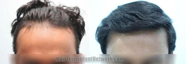 Front view - Before and after hair transplant surgery result images