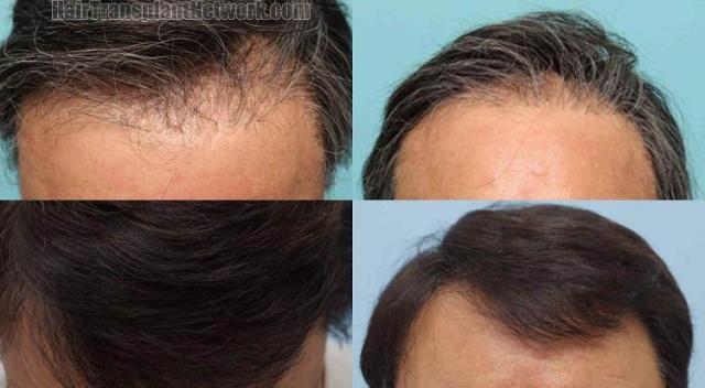 Hair restoration procedure before and after results