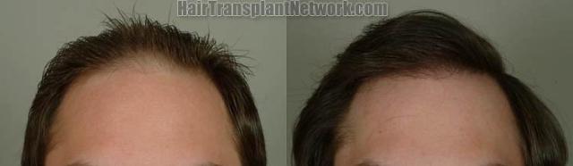 Before and after hair transplant procedure images