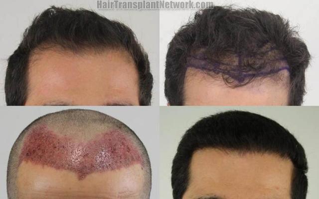 Hair restoration procedure before and after results