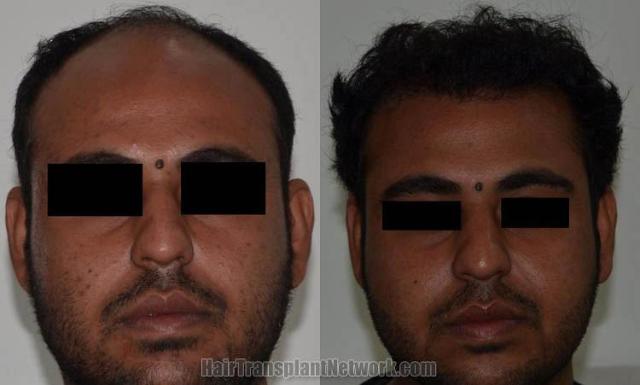 Before and after hair transplant procedure images