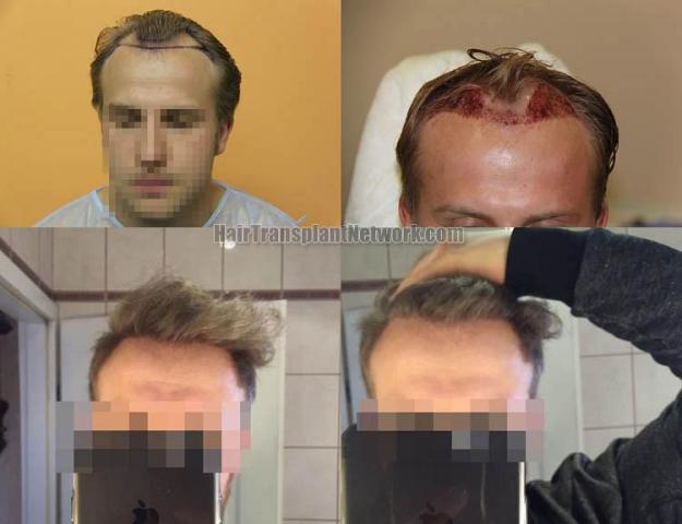 Before and after hair transplant procedure images