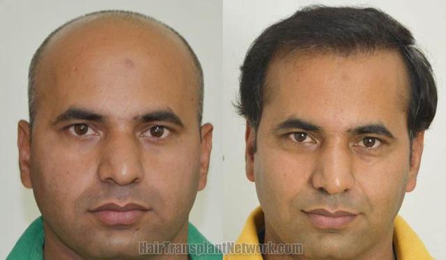 Hair transplantation surgery before and after photos