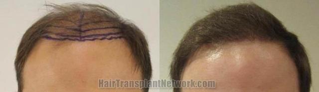 Hair restoration procedure before and after results