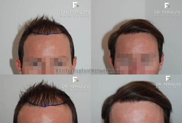 Front view - Before and after hair transplantation surgery