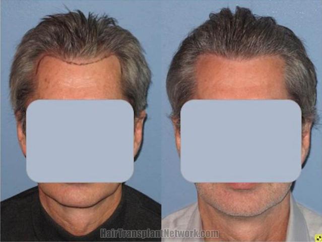 Front view - Before and after hair transplantation surgery