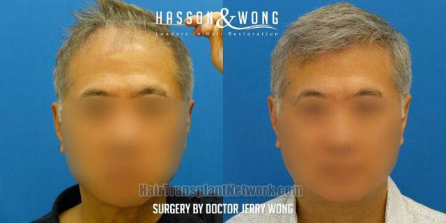 Before and after hair restoration procedure images