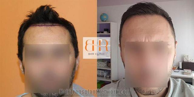 Before and after hair restoration procedure images