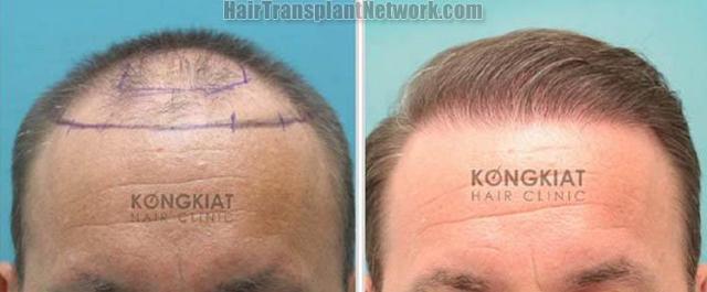 Front view - Before and after hair transplantation surgery