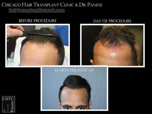 Front view - Before and after hair restoration procedure