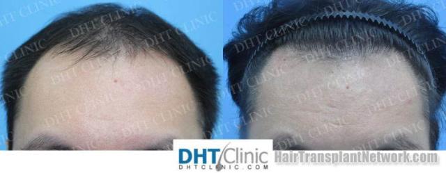 Front view - Before and after hair restoration procedure