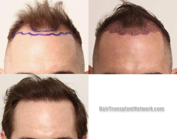 Front view - Before and after hair restoration procedure