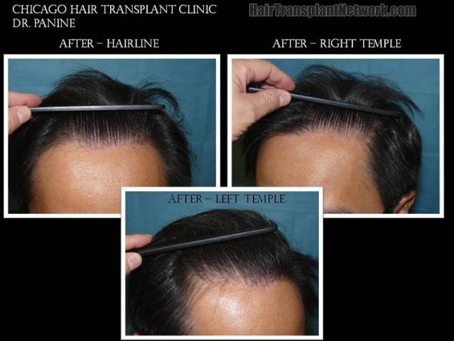 After photos showing closeup views of hairlines