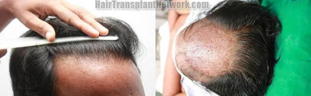 Hair replacement surgery before and after images