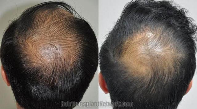 Hair restoration procedure before and after pictures