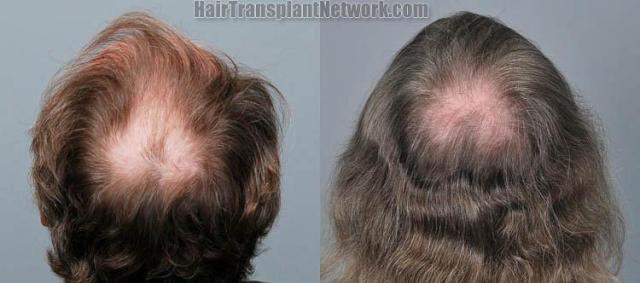 Hair transplantation surgery before and after pictures