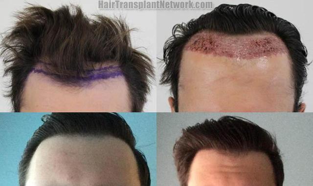 Before and after hair transplant procedure images