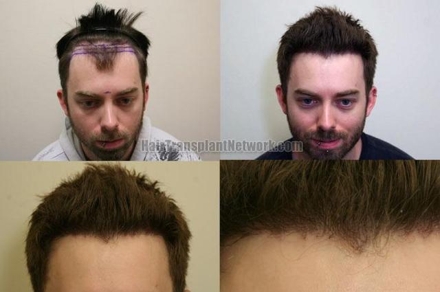 Front view - Before and after hair transplantation