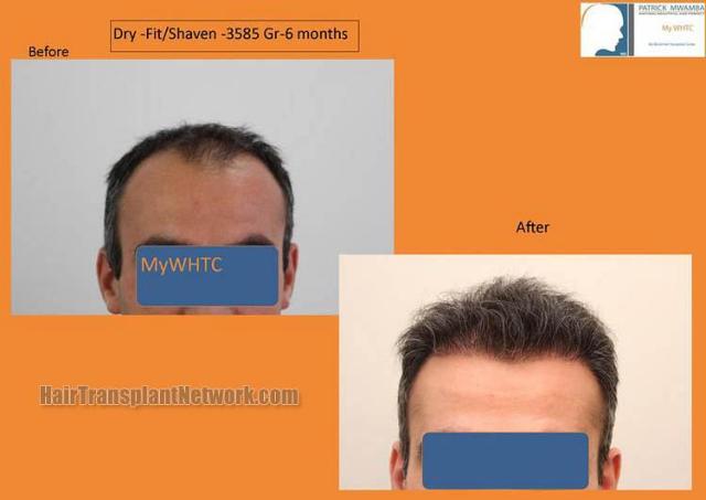 Hair restoration procedure before and after results