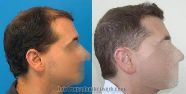 Hair restoration procedure before and after results