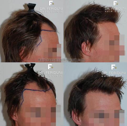 Hair transplantation surgery before and after images