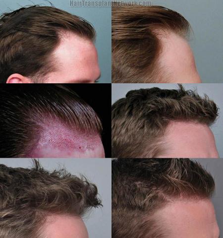 Hair transplantation surgery before and after images