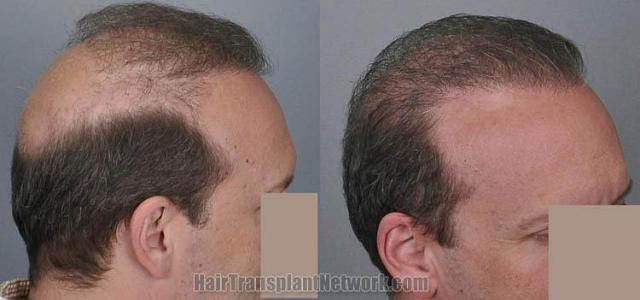 Hair transplantation surgery before and after photos