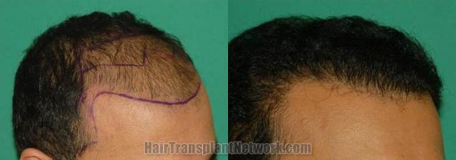 Hair transplantation surgery before and after photos