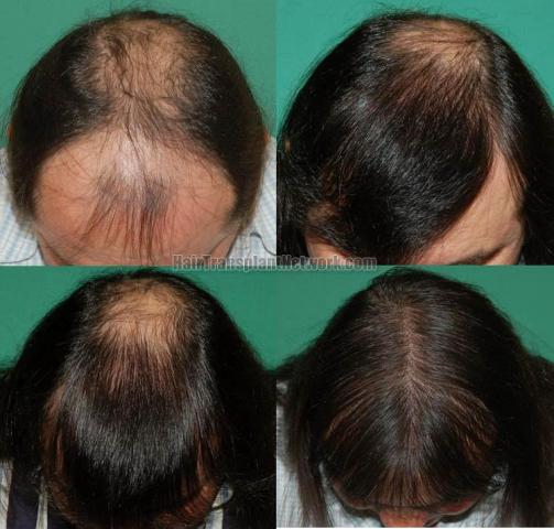 Top view before and after hair restoration results